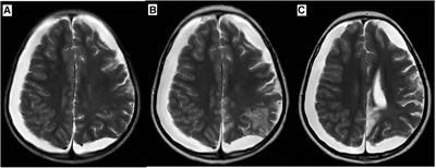 Case Report: Infant-onset Degos disease with nervous system involvement and a literature review